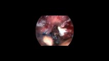 Laparoskopi ile Endometiroma 32  - Prof. Dr. Aydan Biri