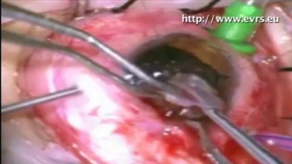 Bimanual Removal of Large Foreign Bodies with a Suture Loop, and a New Foreign Body Forceps Nur Acar