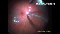 Retinal Detachment Post-Keratoplasty and an Iris-fixed IOL Implantation Daniel Vilaplana