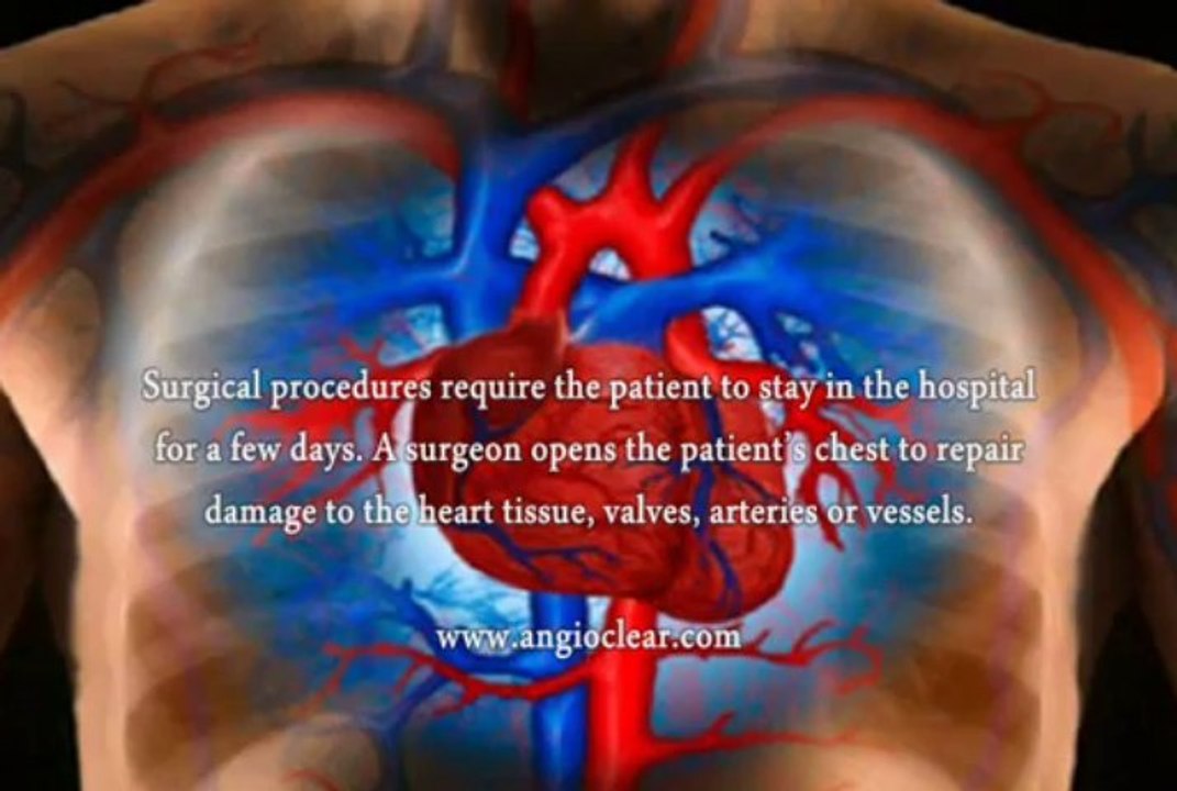 Treatment Options For Cardiovascular Disease, What Are Treatment Options For Cardiovascular Disease