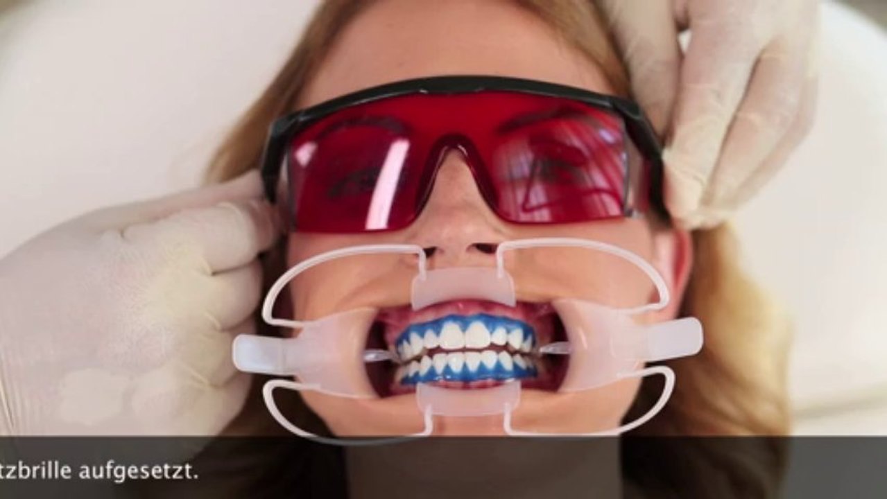 Zahnbleaching, Zahnaufhellung, Lydenti Bleaching, Whitening, Wybielanie, Power-bleaching,