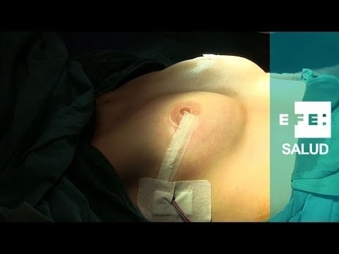 Mastectomía preventiva y reconstrucción mamaria de Beatriz