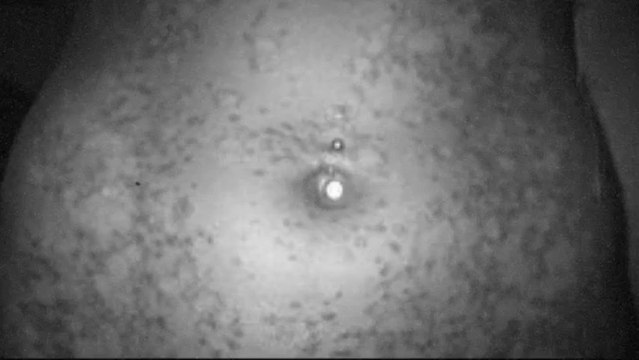 Is Psoriasis Contagious