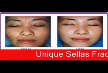 Unique Sellas Fractional Lasers at Ojasaesthetic