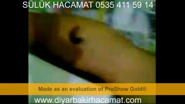 SÜLÜK HACAMAT DİYARBAKIR TEDAVİ MERKEZİ 0535 411 59 14