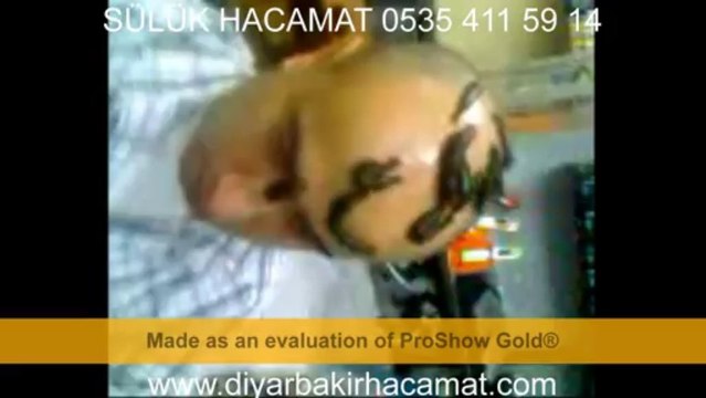 SÜLÜK HACAMAT UYGULAMASI DİYARBAKIR TEDAVİ MERKEZİ 0535 411 59 14