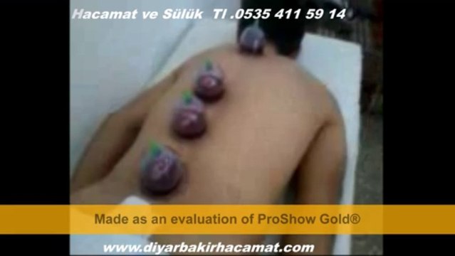 SÜLÜK HACAMAT DİYARBAKIR TEDAVİ 0535 411 59 14