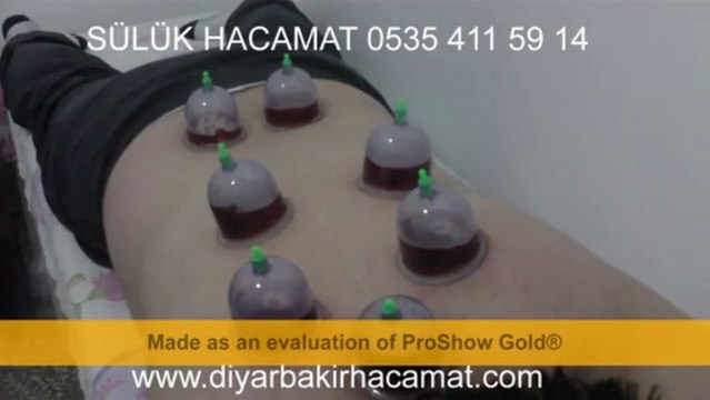 HACAMAT SÜLÜK TEDAVİSİ DİYARBAKIR 0535 411 59 14