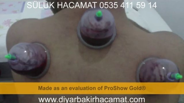 HACAMAT TEDAVİSİ DİYARBAKIR 0535 411 59 14