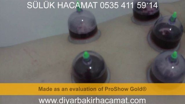 SÜLÜK HACAMAT TEDAVİSİ DİYARBAKIR'da 0535 411 59 14