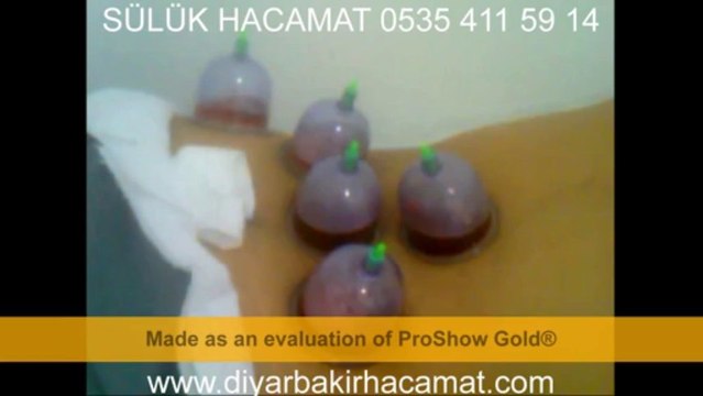 SÜLÜK HACAMAT TEDAVİSİ DİYARBAKIR 0535 411 59 14