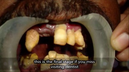 severe gum problem.. what to do ?