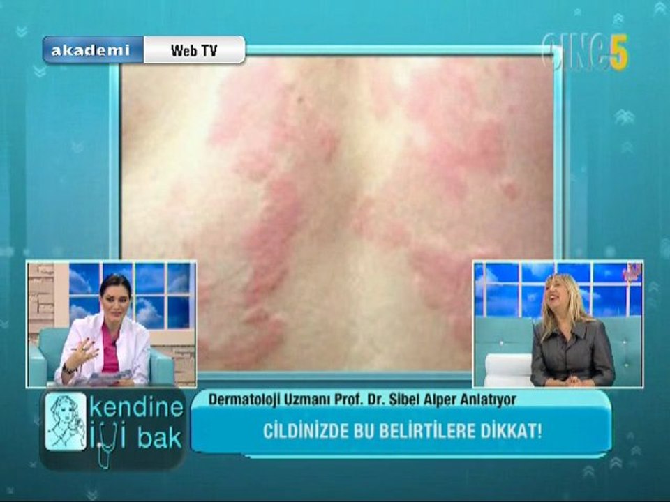 Kendine iyi bak - Kurdeşen ve uyuz nedir? Bulaşıcı mı? Sebep ve tedavisi nedir?