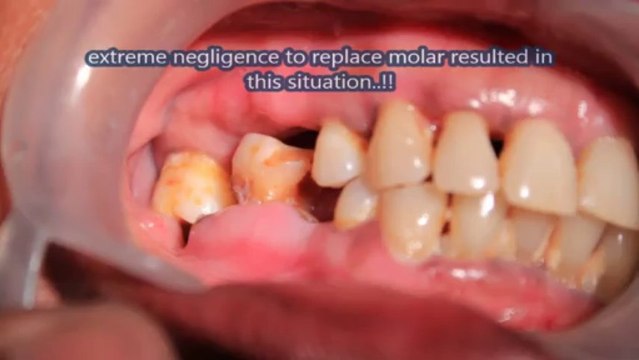 Extreme negligence to replace missing molar teeth by a patient!