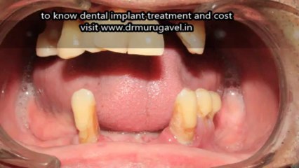 dental implants for diabetic patients in india