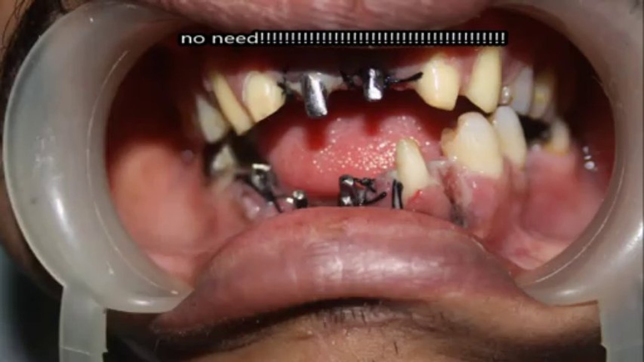 implant without bonegraft in india
