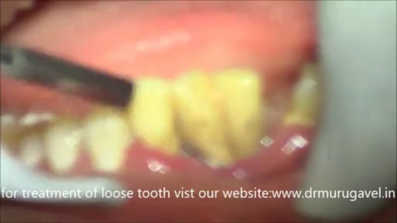 untreated chronic periodontitis