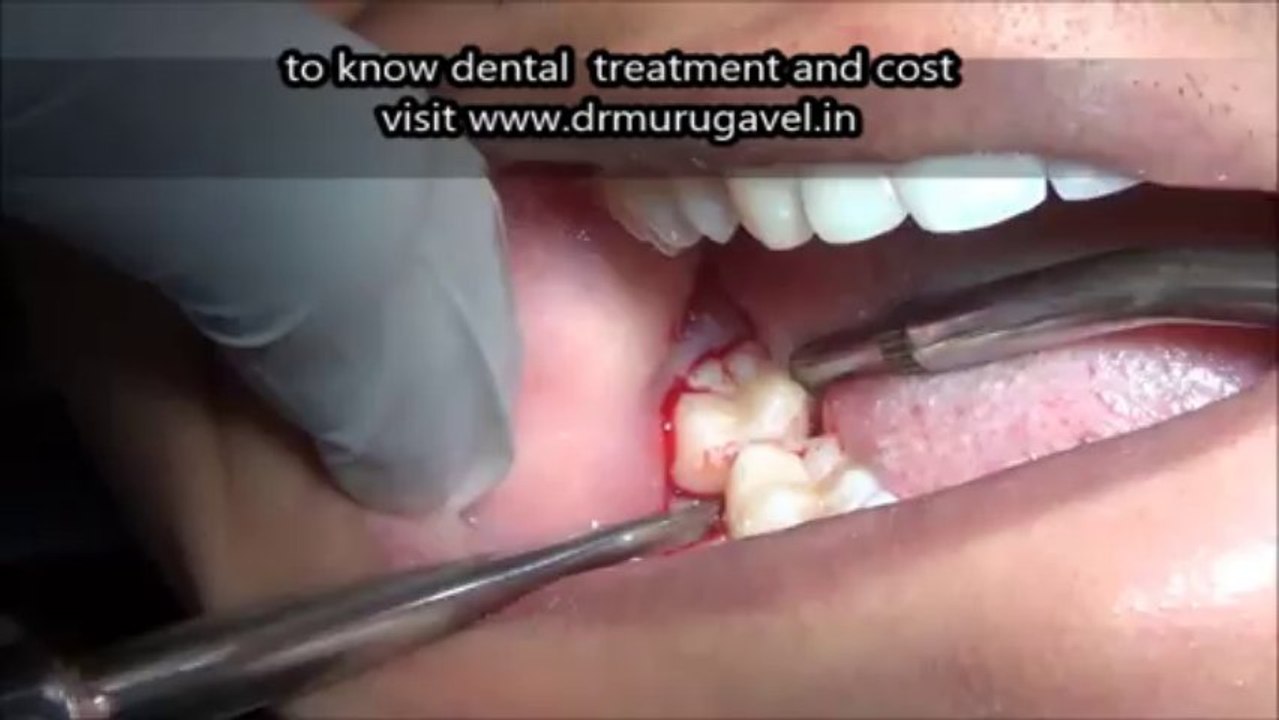 pericoronitis wisdom tooth extraction in india