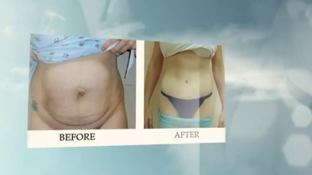 Abdominal Wall Reconstruction Miami Fl - Face + FaceBody Plastic Surgery