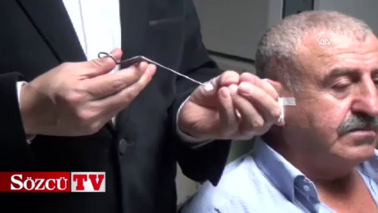 Sigara kağıdıyla kulak zarı tedavisi - Dailymotion Video