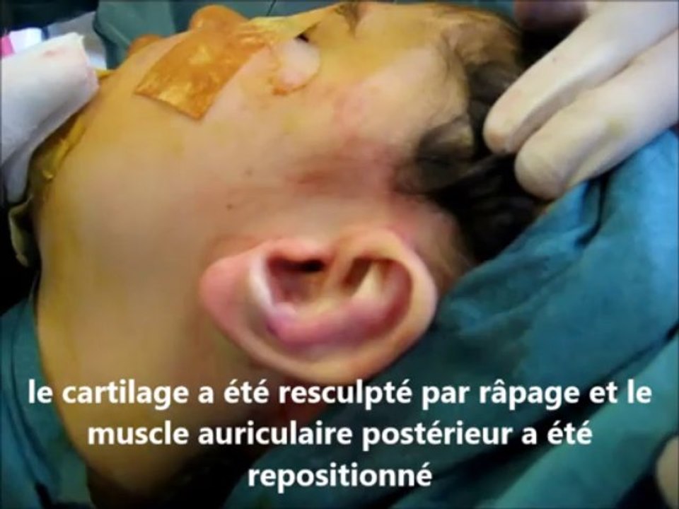 oreilles décollées technique