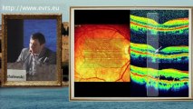 Early Onset Exudative AMD Detected with Monthly SD-OCT with Eye-tracking of the Fellow Eye in Patients Treated with Anti-VEGF Janusz Michalewski