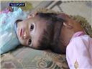 قصة طفلتين سوريتين برأسين ملتصقين