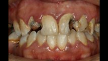 Cosmetic Dentist Sydney - Before and After - Implants, Porcelain Veneer