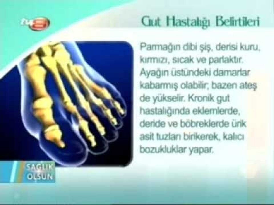 Gut Hastalığı Nedir Belirtileri Tedavisi-Gut Hastalığı Nasıl Geçer
