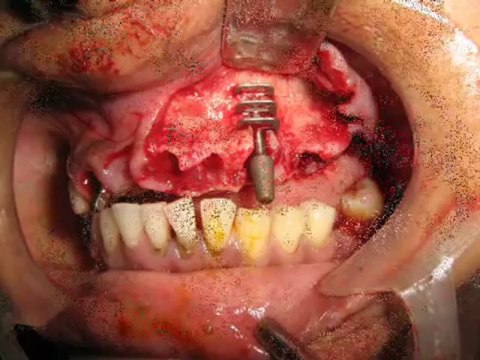 Basal Implants in chennai(BOI).wmv