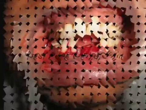 Immediate new teeth replacement by BCS (Basal Cortical Screw) Implants