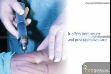 Ultrasonic Liposuction