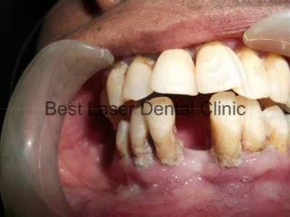 Immediate teeth replacement by dental  implant treatment- in NDIA