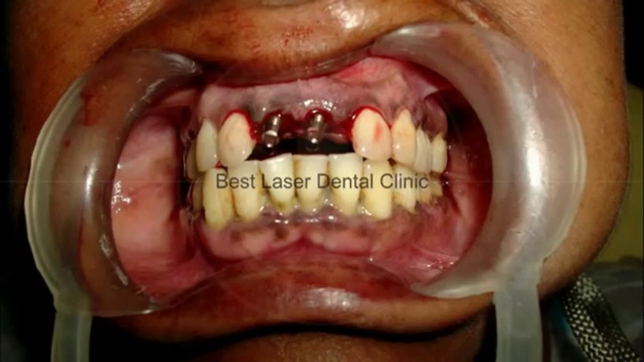 Must watch for removable denture wearers -INDIA