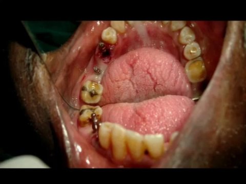 Painless extraction of periapical abscess tooth and implant supported bridge in india-chennai