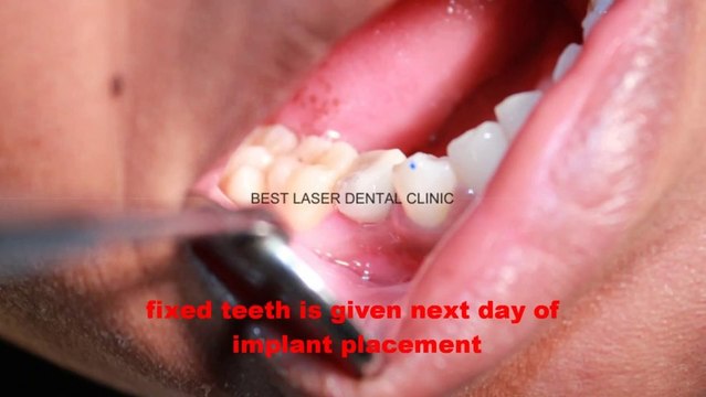Painless removal of retained milk tooth, placing an implant and crown in chennai,india