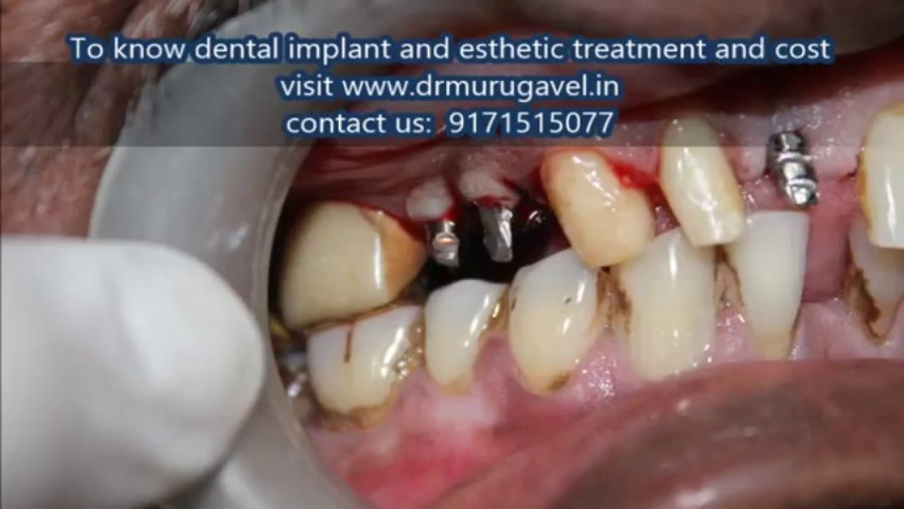 Affordable dental implants in india
