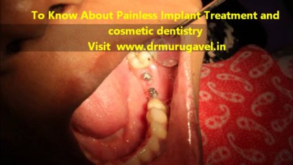 Dental implant centre-india
