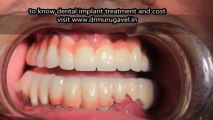 Are Diabetic patients suitable for dental implants _ INDIA