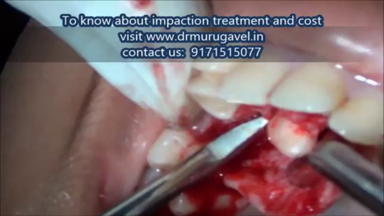 Canine impaction procedure video-india