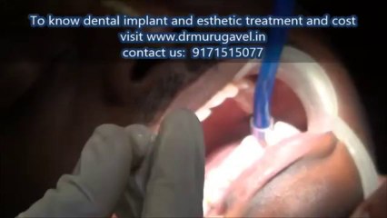 cementation of PFM ceramic bridge - Implant supported in india