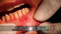 excision of mucocele in lip with dental laser in india