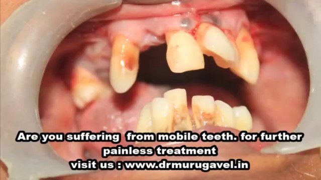 Final stage of generalised periodontitis neglected teeth!!