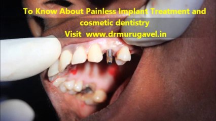 Painless dental implant treatment in india