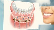 How much does a dental implant cost