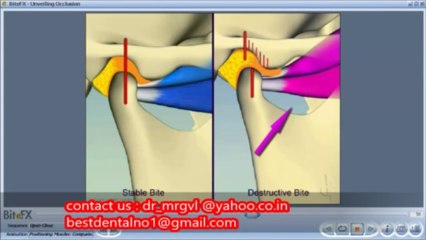 Treatment for TMD, temperomandibular joint pain and dysfunction in chennaiINDIA