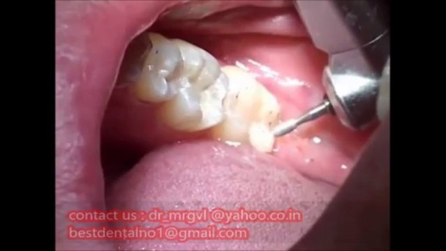 TEMPEROMANDIBULAR JOINT pain causes and treatment methods in chennai-INDIA