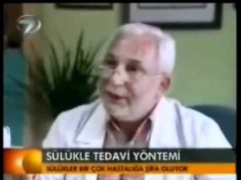 Sülük tedavisi nedir nasıl yapılır-Sülük tedavisinin faydaları-Sülük neye iyi gelir