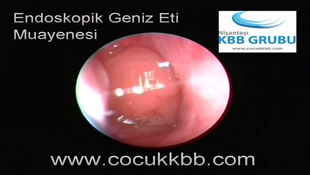 Çocuklarda Geniz Eti Muayenesi