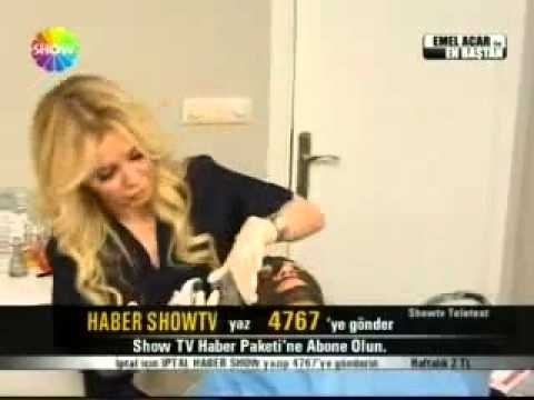 Benler Nasıl Geçer-Ben Tedavisi (Fraksiyonel CO2 Lazer Tedavi)